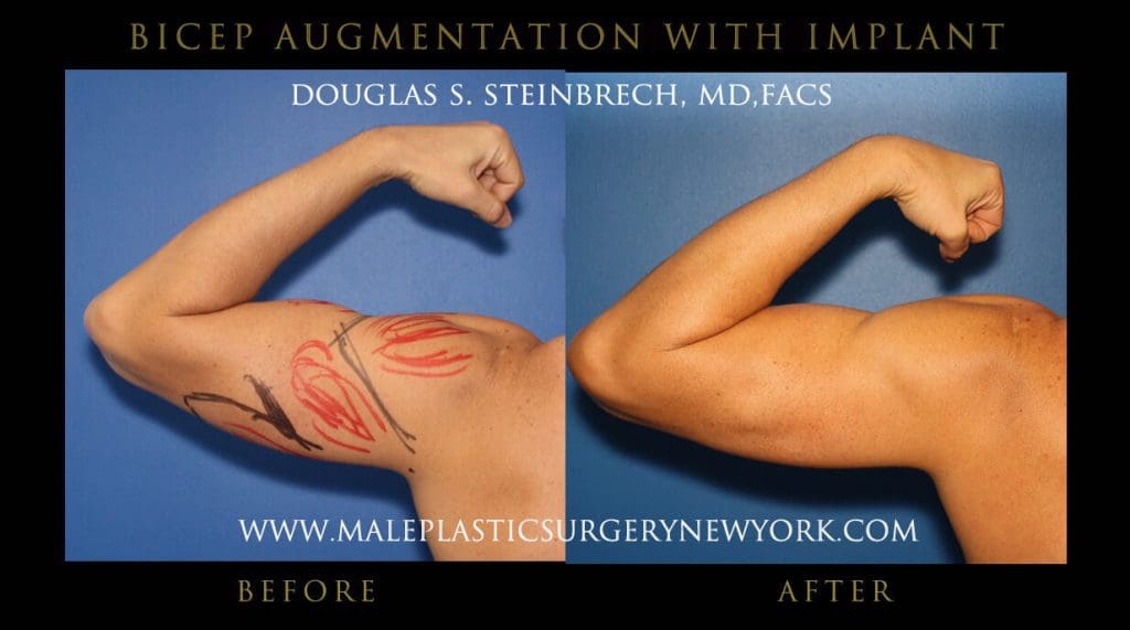 bicepaugmeny2