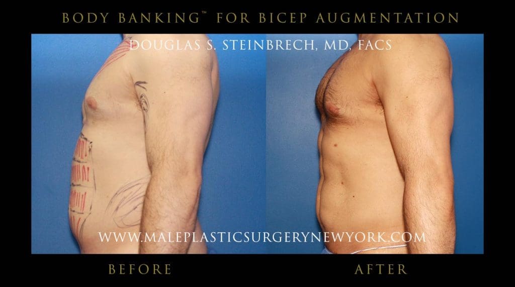 body-banking-for-bicep-augmentation-left