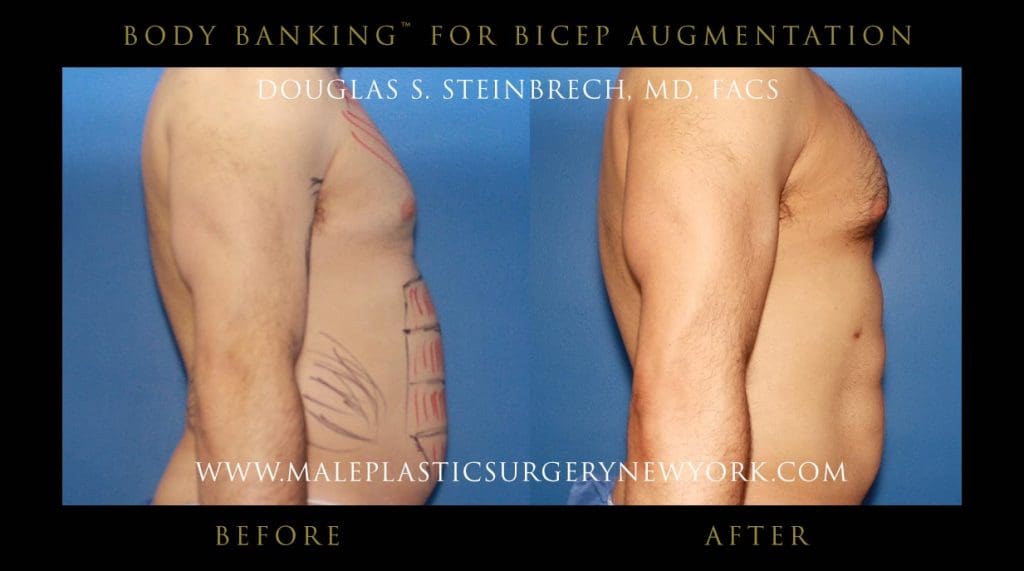 body-banking-for-bicep-augmentation-right