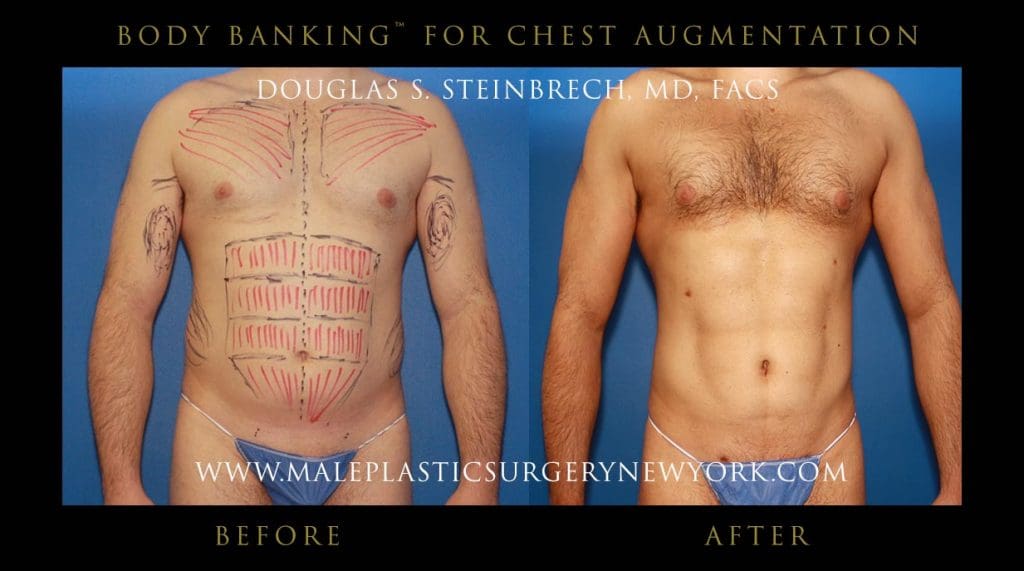 body-banking-for-chest-augmentation-front
