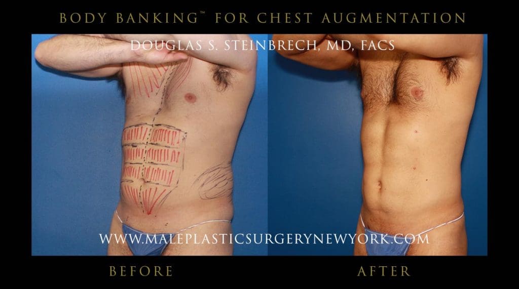 body-banking-for-chest-augmentation-front-left-1