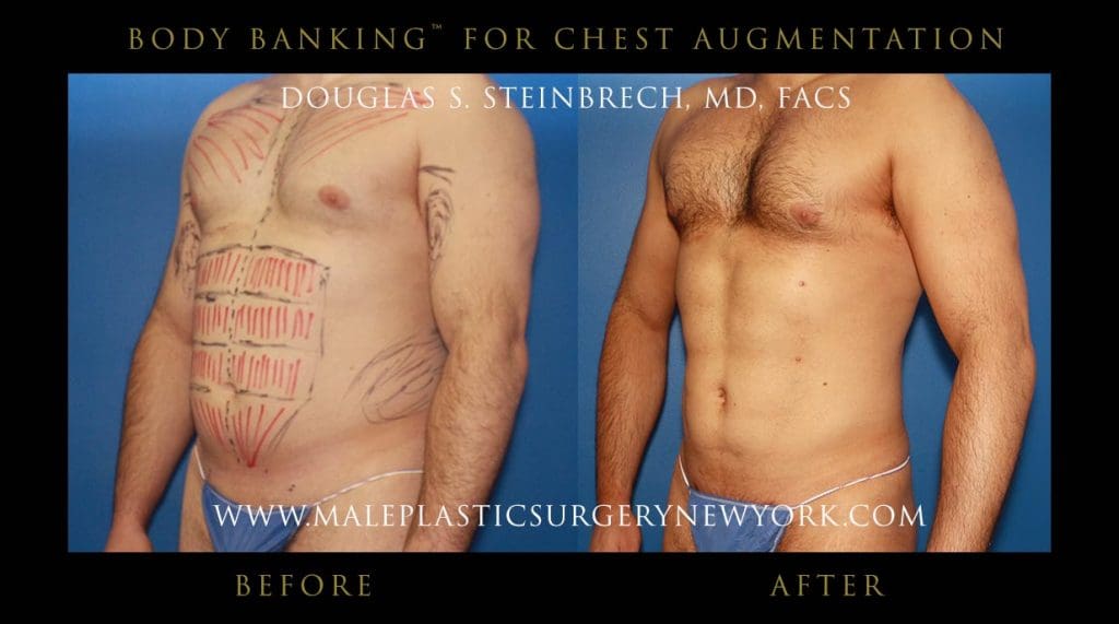 body-banking-for-chest-augmentation-front-left
