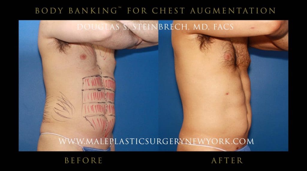 body-banking-for-chest-augmentation-front-right-1