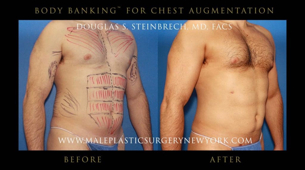 body-banking-for-chest-augmentation-front-right