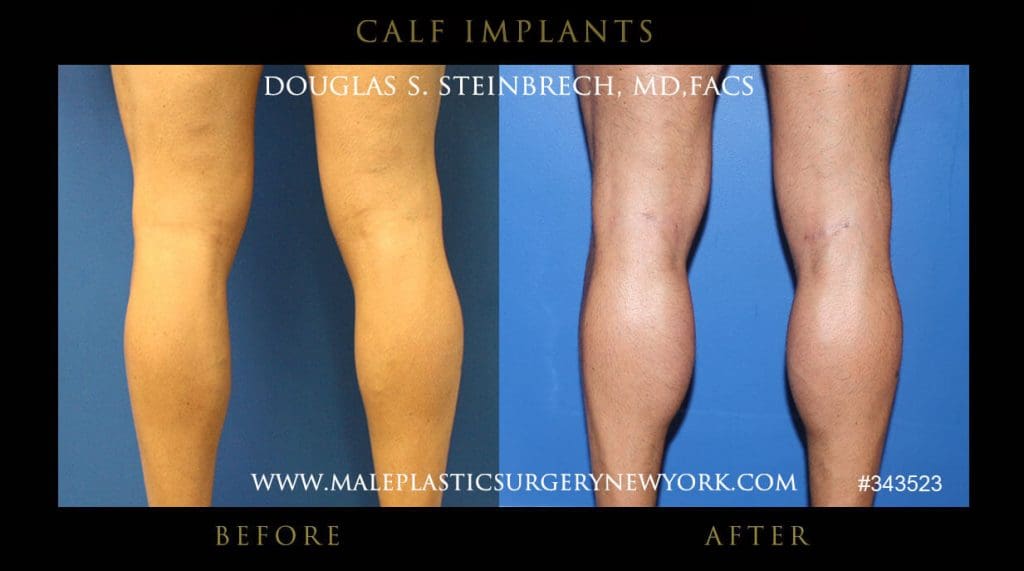 Calf Implants