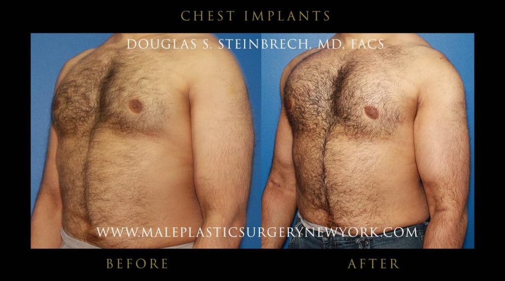 chest-implant-front-left