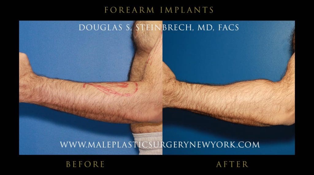 forearm-implants-left