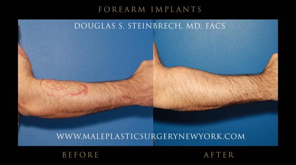 forearm-implants-right