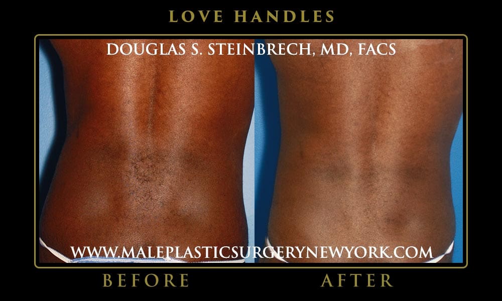 love-handles-liposuction-NYC-01