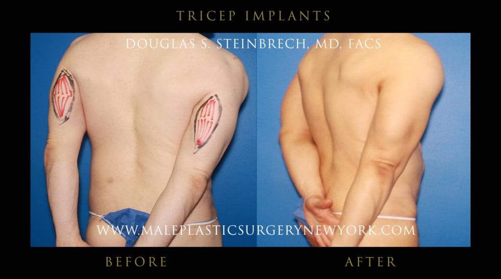 tricep-implants-NYC-before-after-02-back-right