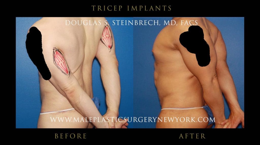tricep-implants-NYC-before-after-photos-01