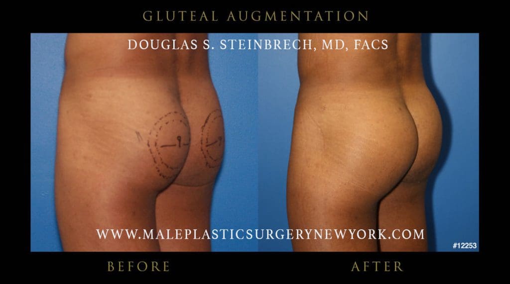 Gluteal-augmentation-NYC-before-after-1-12253