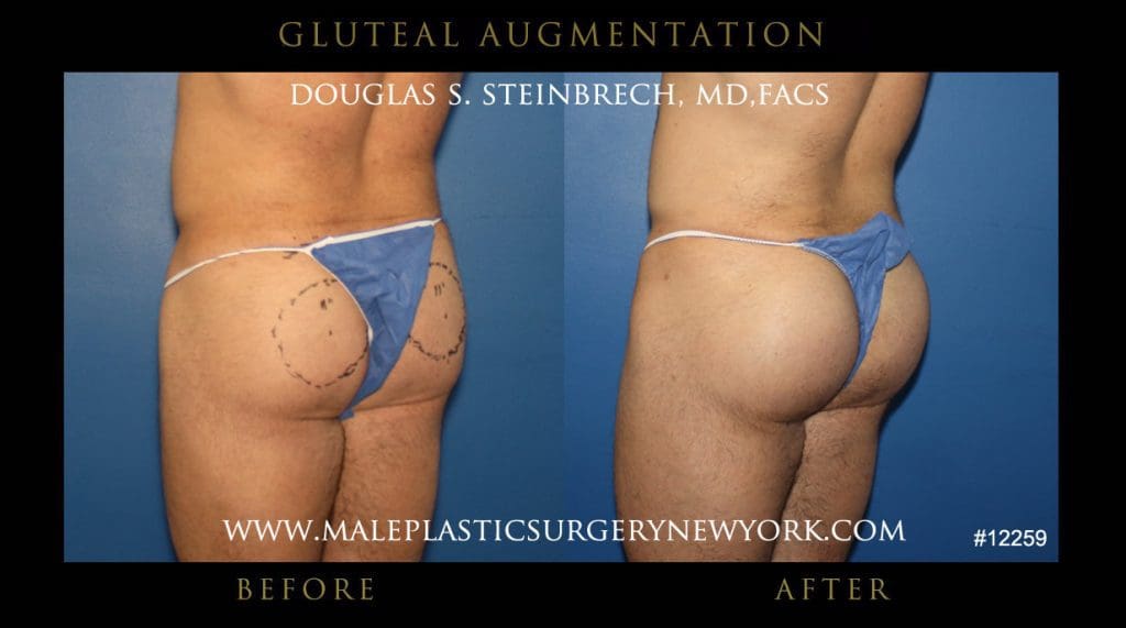 gluteal-aug-mps-ny-10