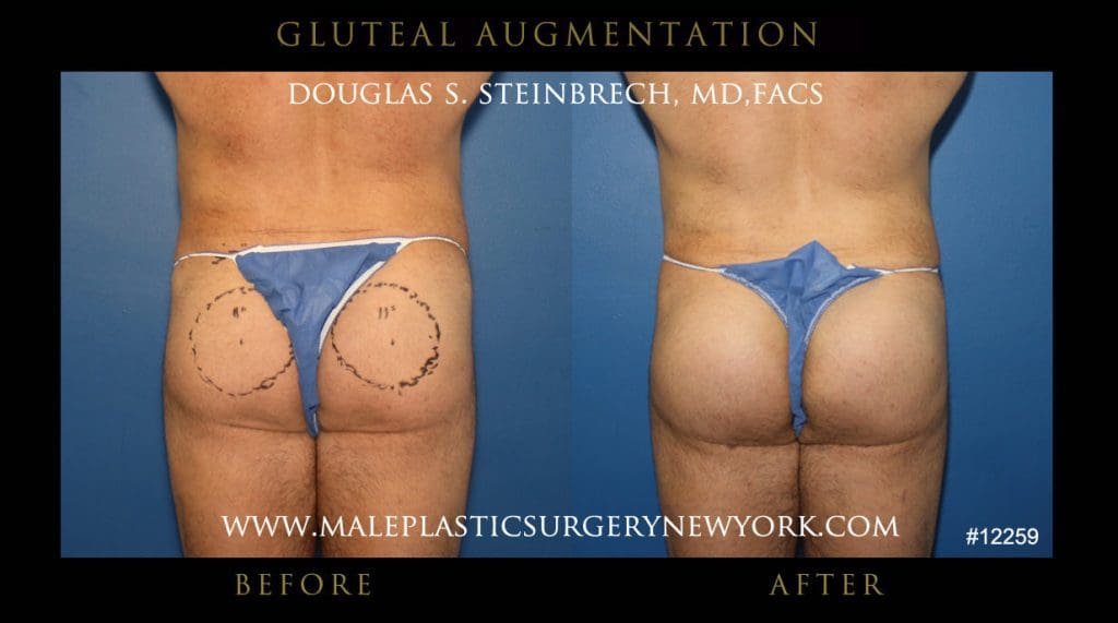 gluteal-aug-mps-ny-11