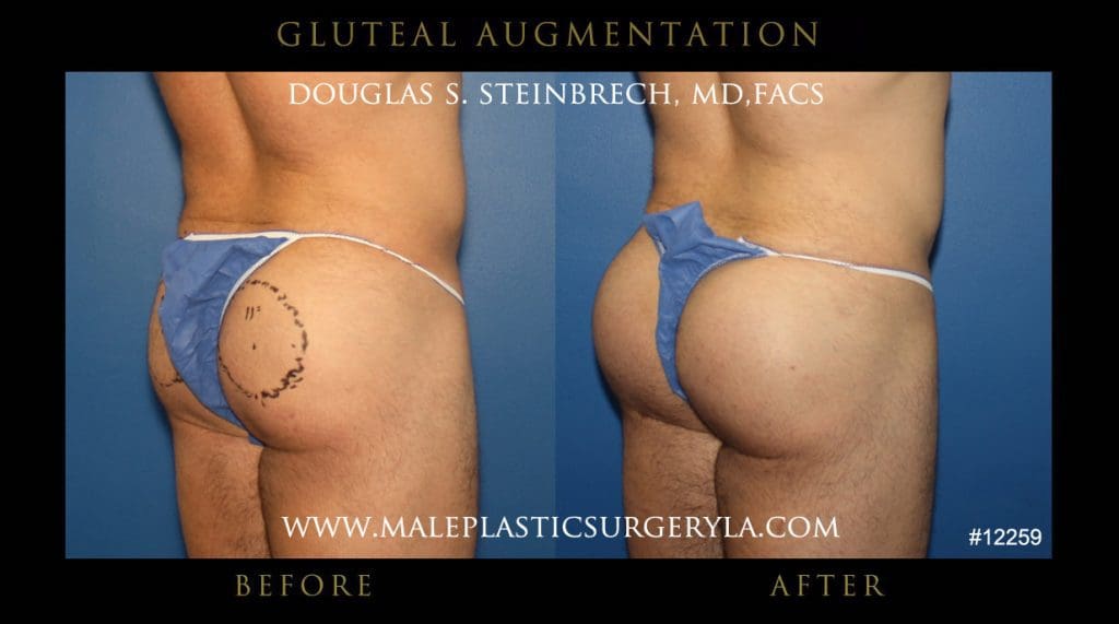 gluteal-aug-mps-ny-12