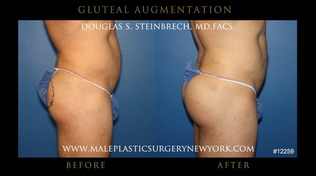 gluteal-aug-mps-ny-13
