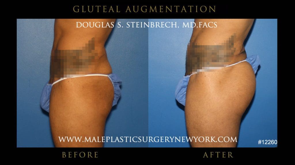 gluteal-aug-mps-ny-14