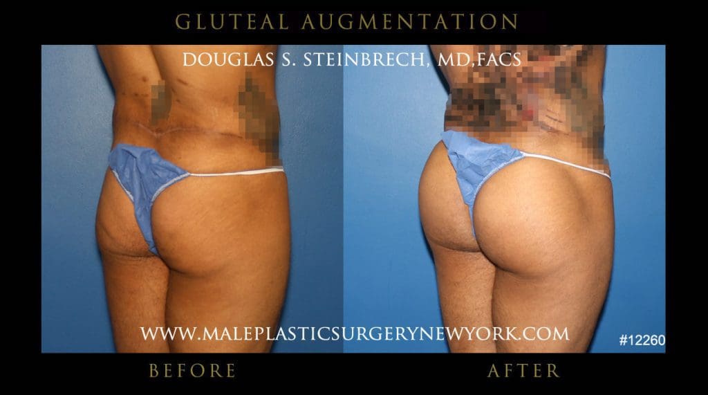gluteal-aug-mps-ny-15
