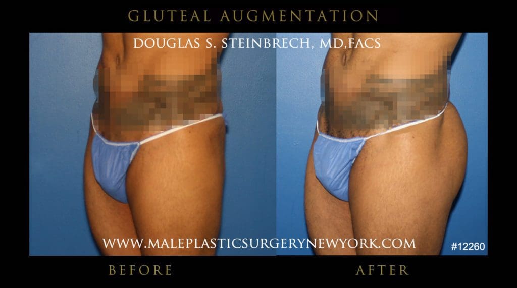 gluteal-aug-mps-ny-16