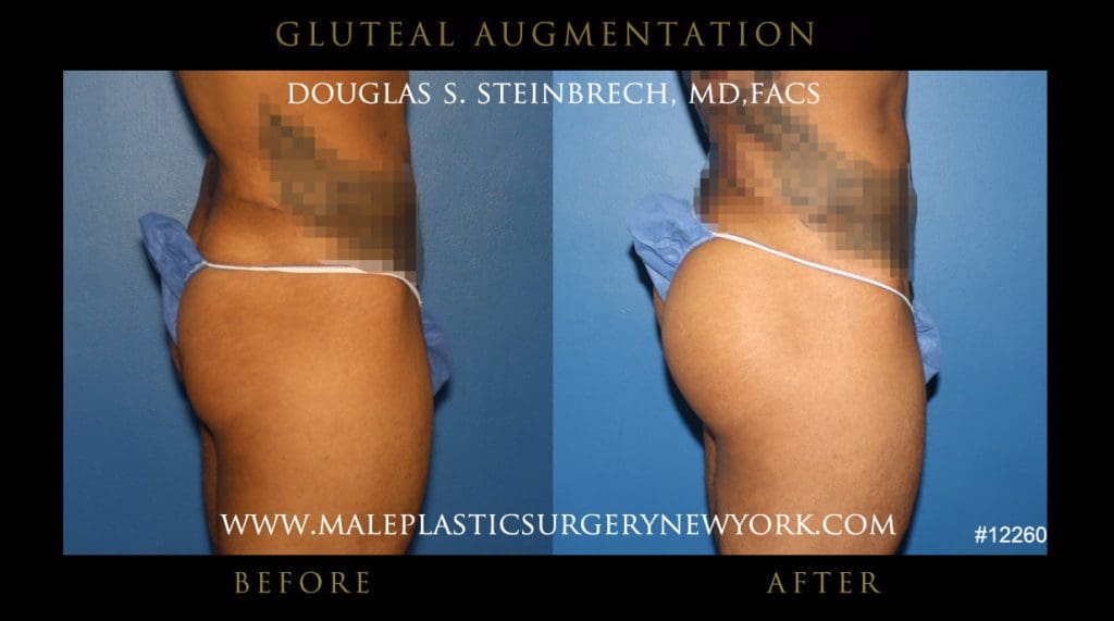 gluteal-aug-mps-ny-17