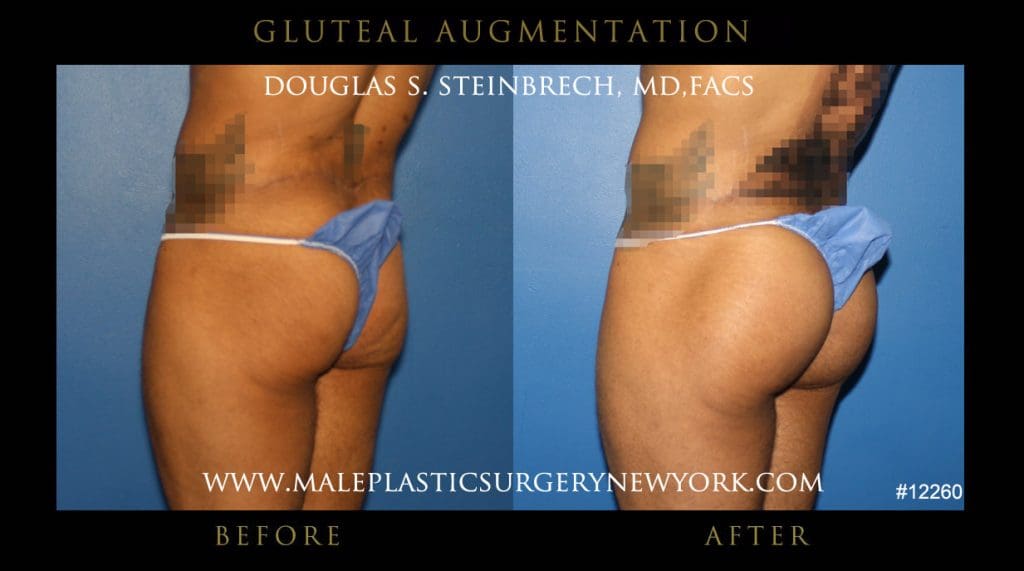 gluteal-aug-mps-ny-18