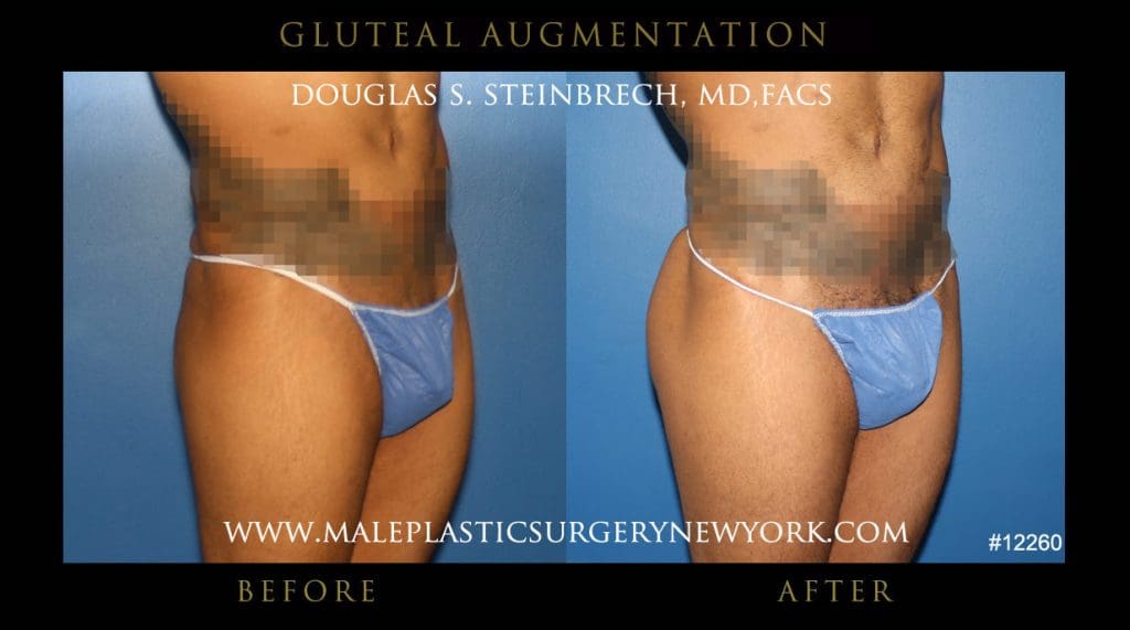 gluteal-aug-mps-ny-19