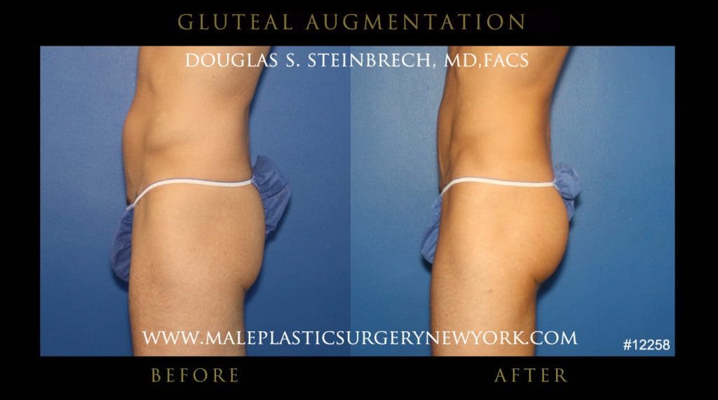 gluteal-aug-mps-ny-2