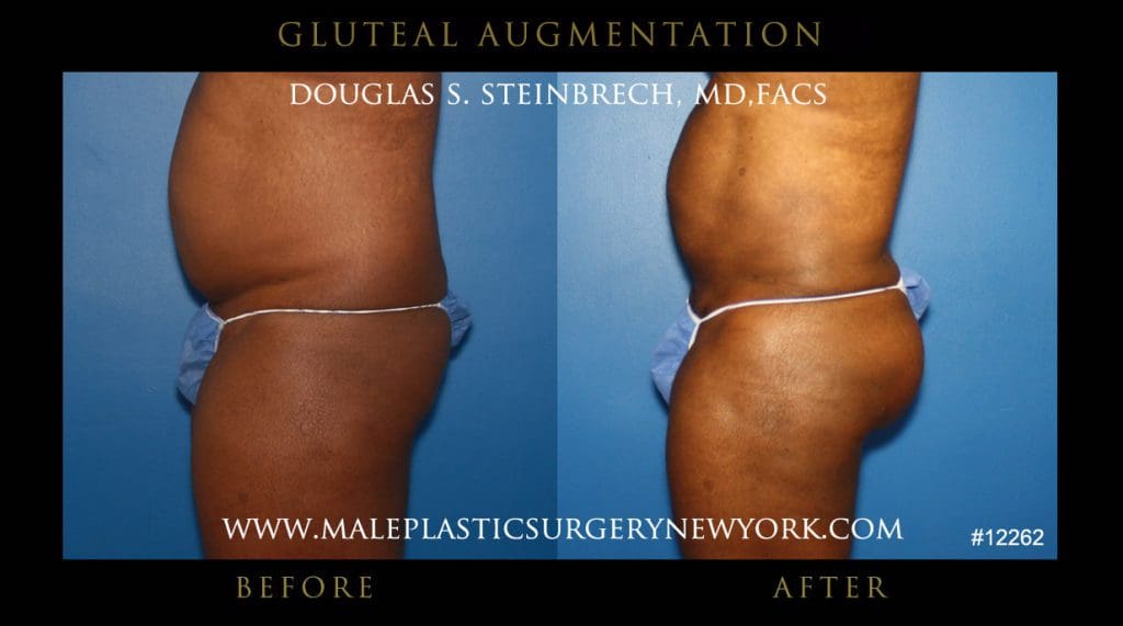 gluteal-aug-mps-ny-20