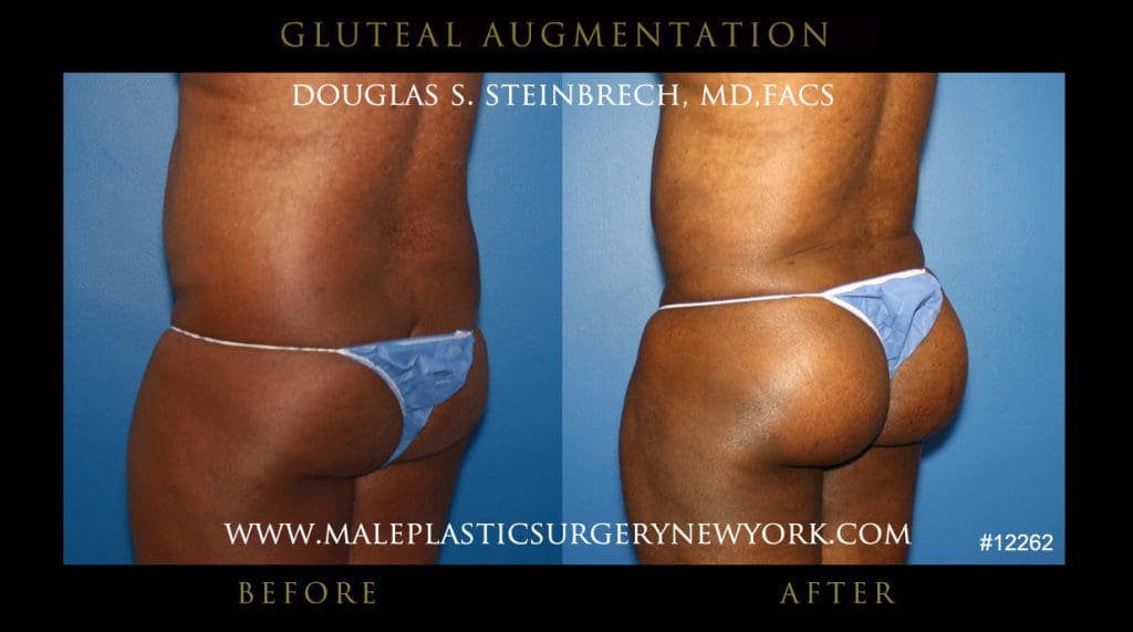 gluteal-aug-mps-ny-21