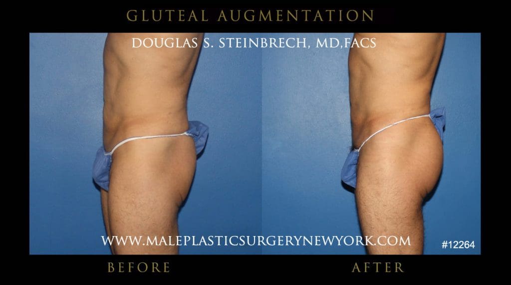 gluteal-aug-mps-ny-22