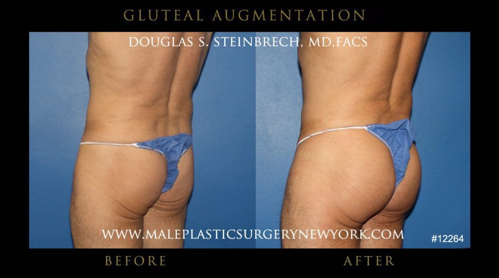 gluteal-aug-mps-ny-23