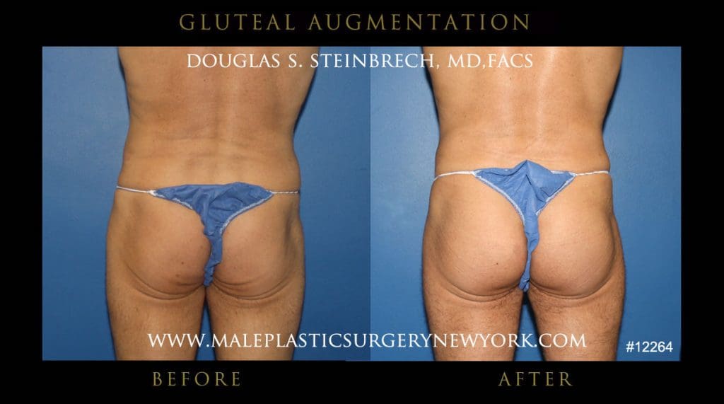 gluteal-aug-mps-ny-24