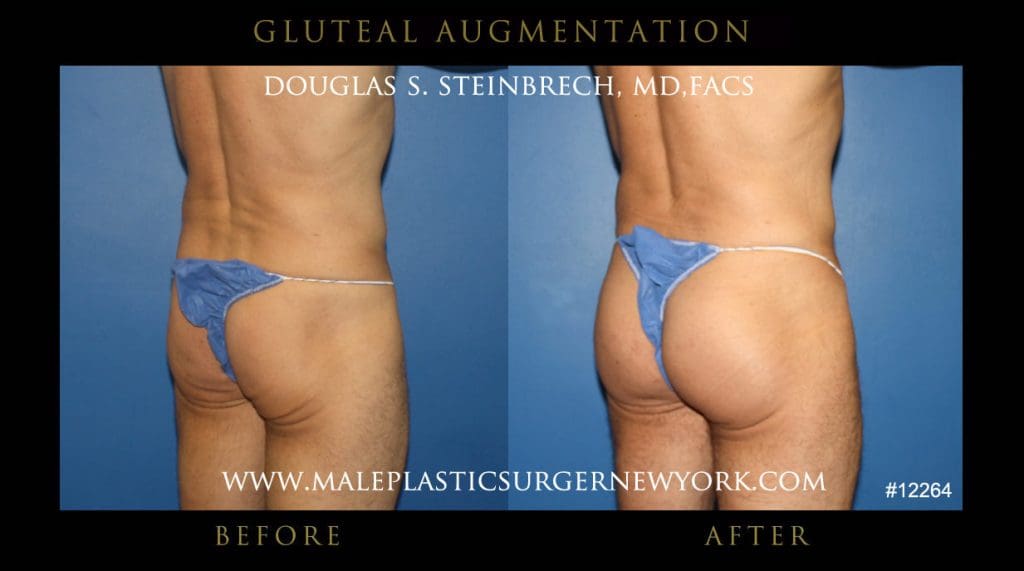 gluteal-aug-mps-ny-25