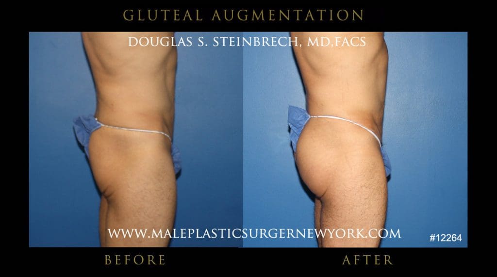 gluteal-aug-mps-ny-26