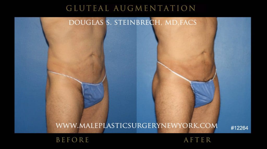 gluteal-aug-mps-ny-27