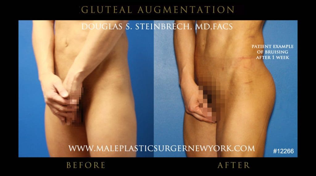 gluteal-aug-mps-ny-28