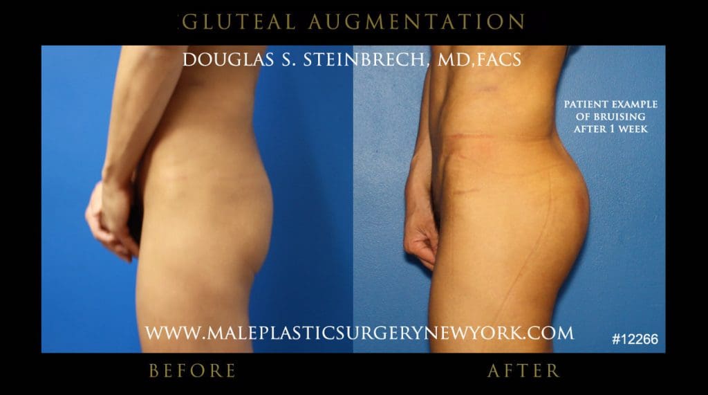 gluteal-aug-mps-ny-29