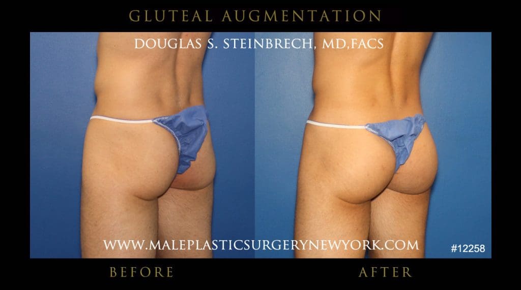 gluteal-aug-mps-ny-3