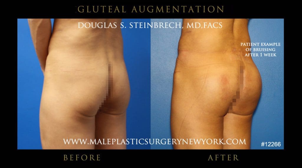 gluteal-aug-mps-ny-30