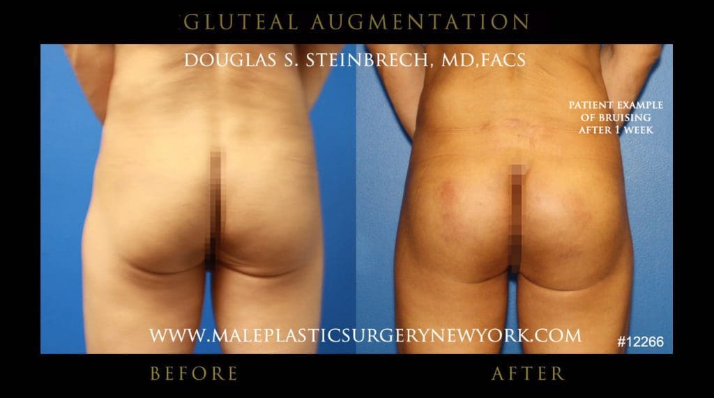 gluteal-aug-mps-ny-31