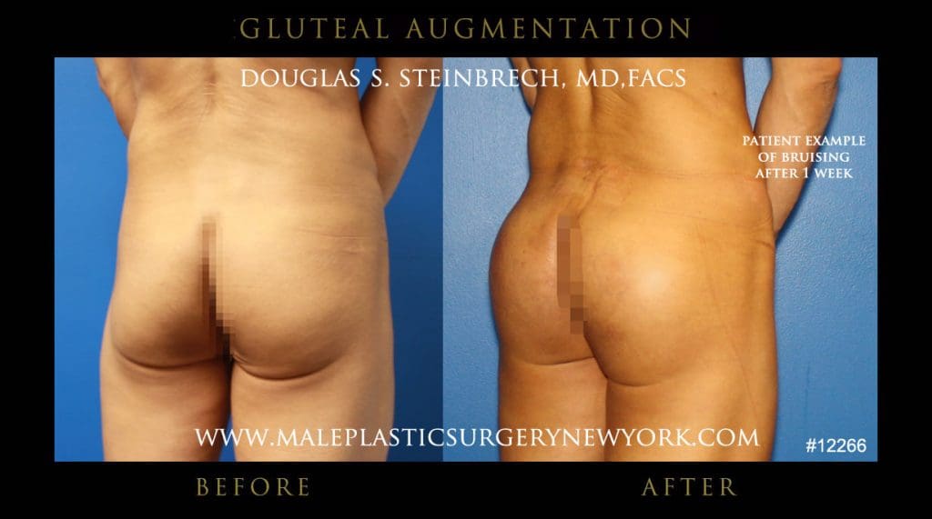 gluteal-aug-mps-ny-32