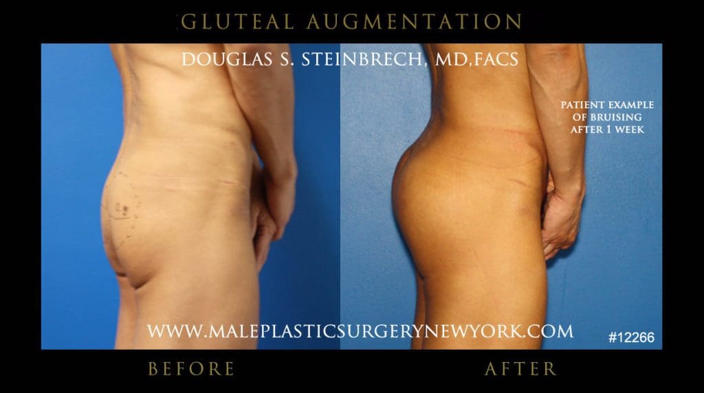 gluteal-aug-mps-ny-33
