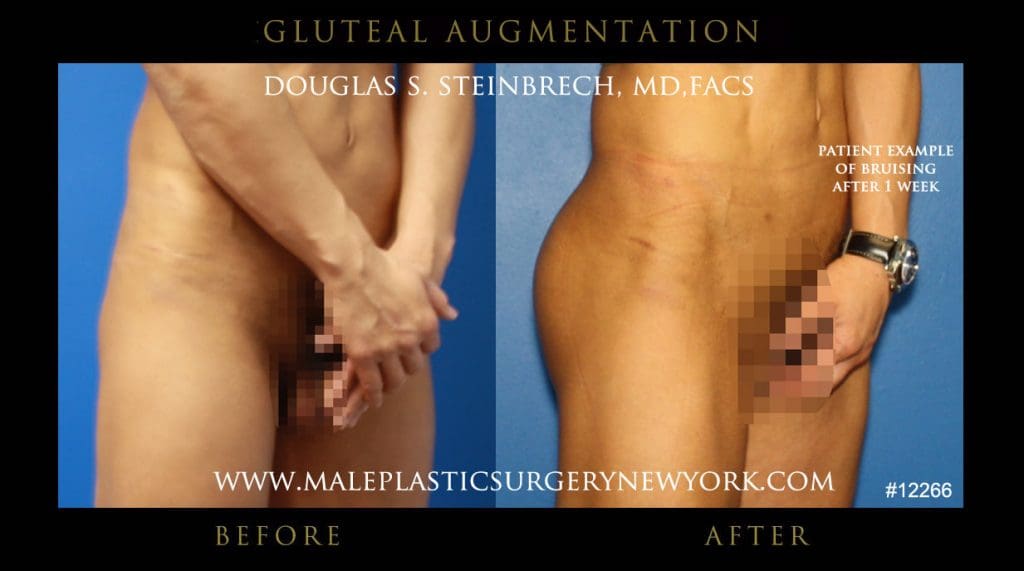 gluteal-aug-mps-ny-34
