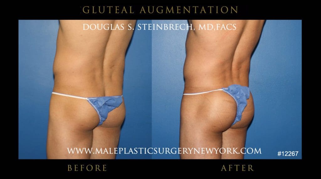 gluteal-aug-mps-ny-35