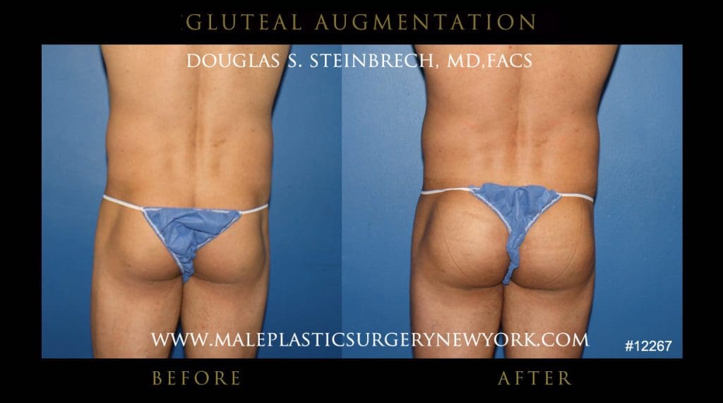 gluteal-aug-mps-ny-36