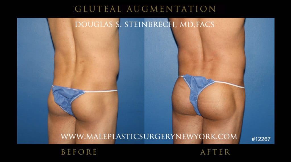 gluteal-aug-mps-ny-37