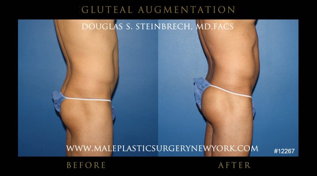 gluteal-aug-mps-ny-38