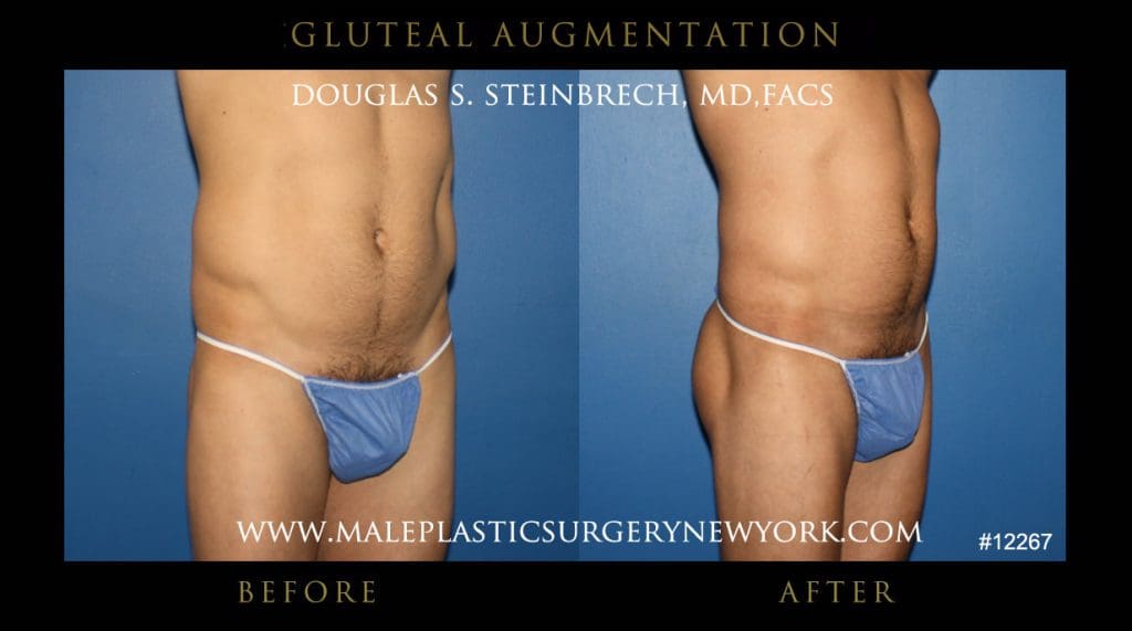 gluteal-aug-mps-ny-39