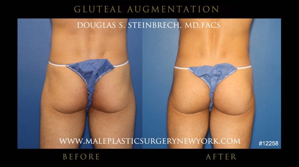 gluteal-aug-mps-ny-4