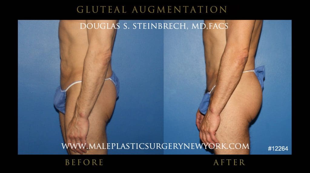 gluteal-aug-mps-ny-40